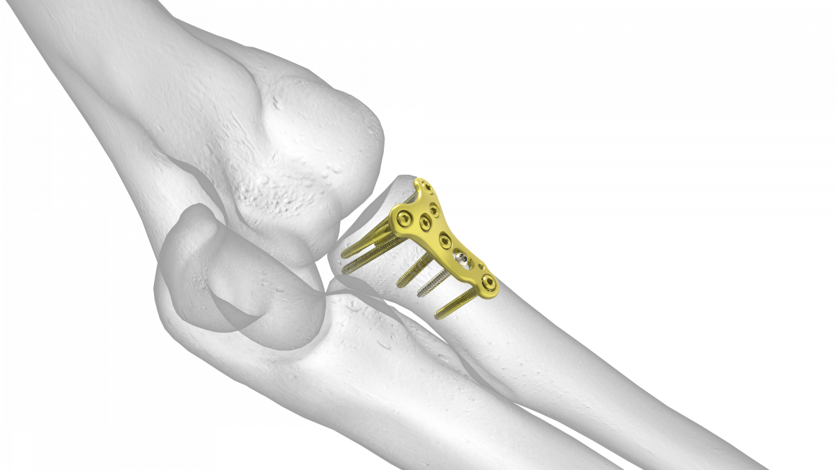 Radial Head Plate Acumed